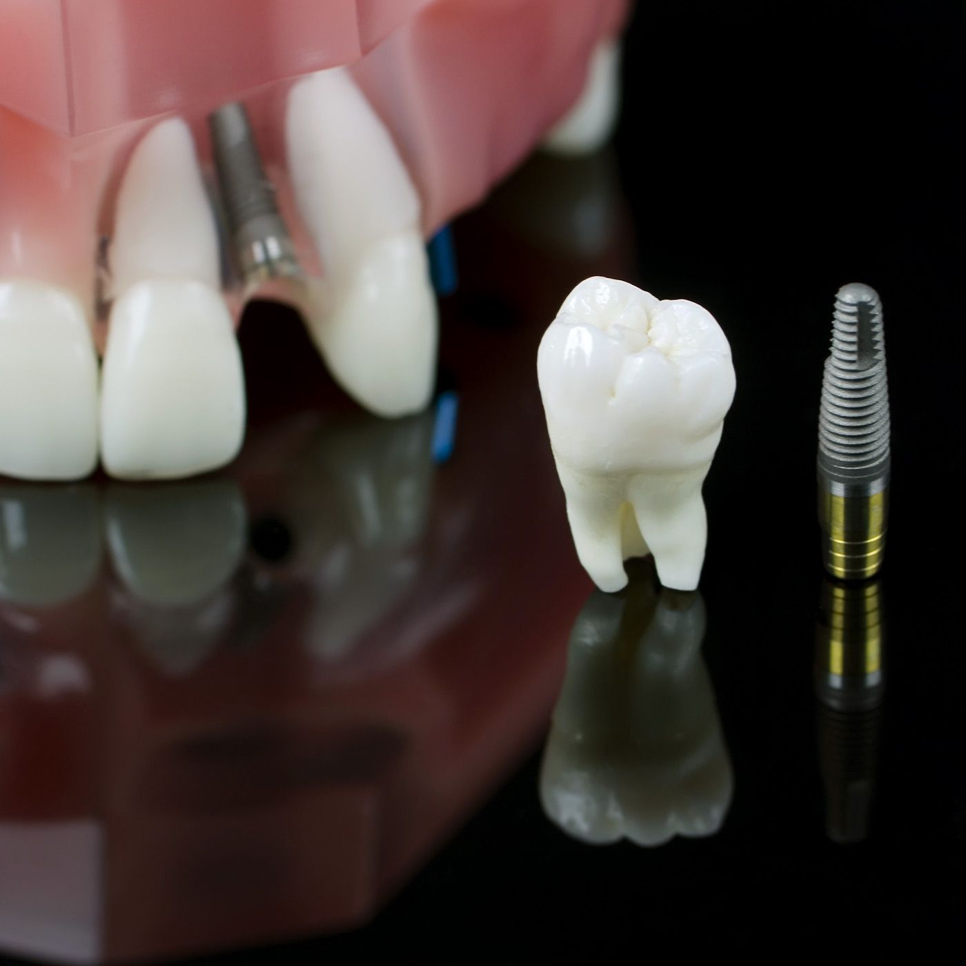 Model of teeth and implant