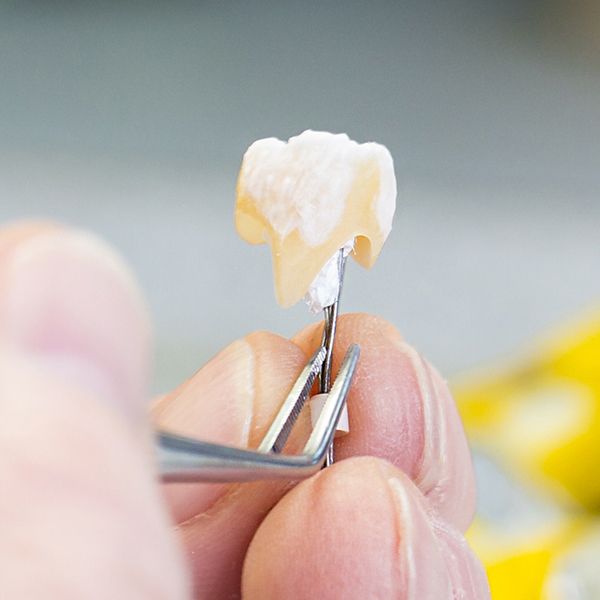 Tooth-colored restoration