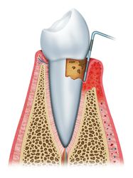 Periodontitis