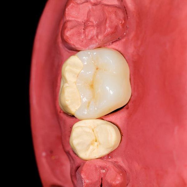 Model of jawbone and teeth from above