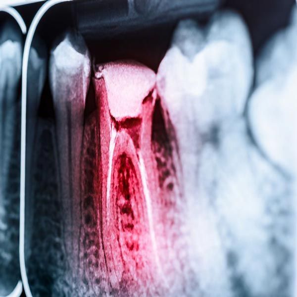 X-ray of infected tooth